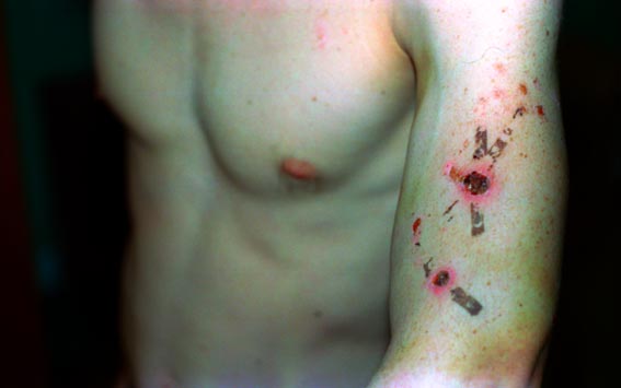 Bite marks from a police dog.